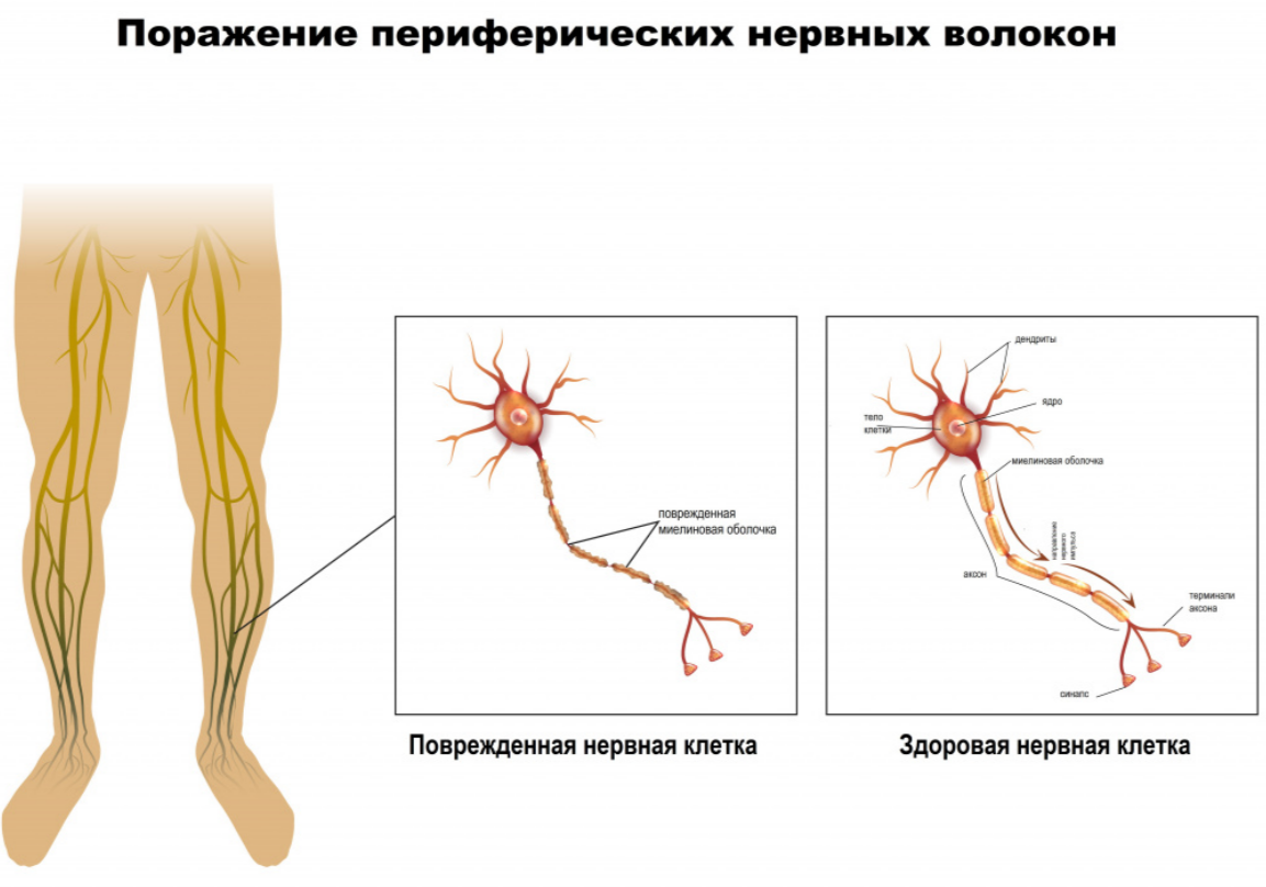 Полинейропатия стоп. Полинейропатия верхних конечностей. Нейропатия нижних конечностей. Периферическая нейропатия ногтей.