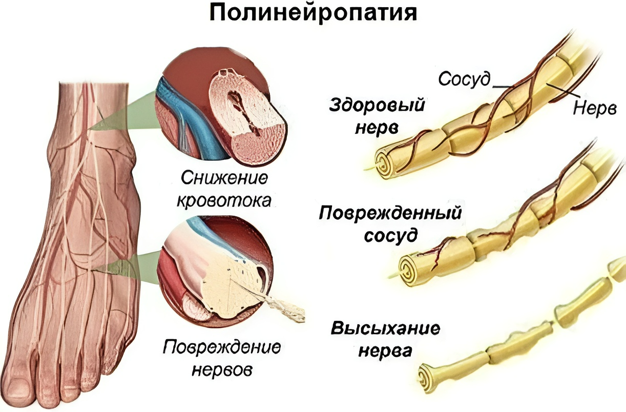 Полинейропатия - лечение, симптомы, причины, диагностика | Центр Дикуля