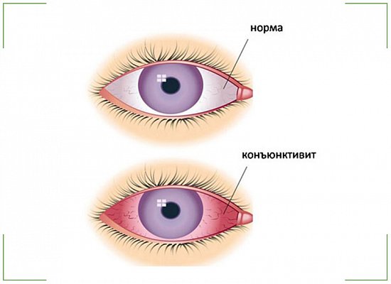 Конъюнктивит у ребёнка: симптомы и лечение