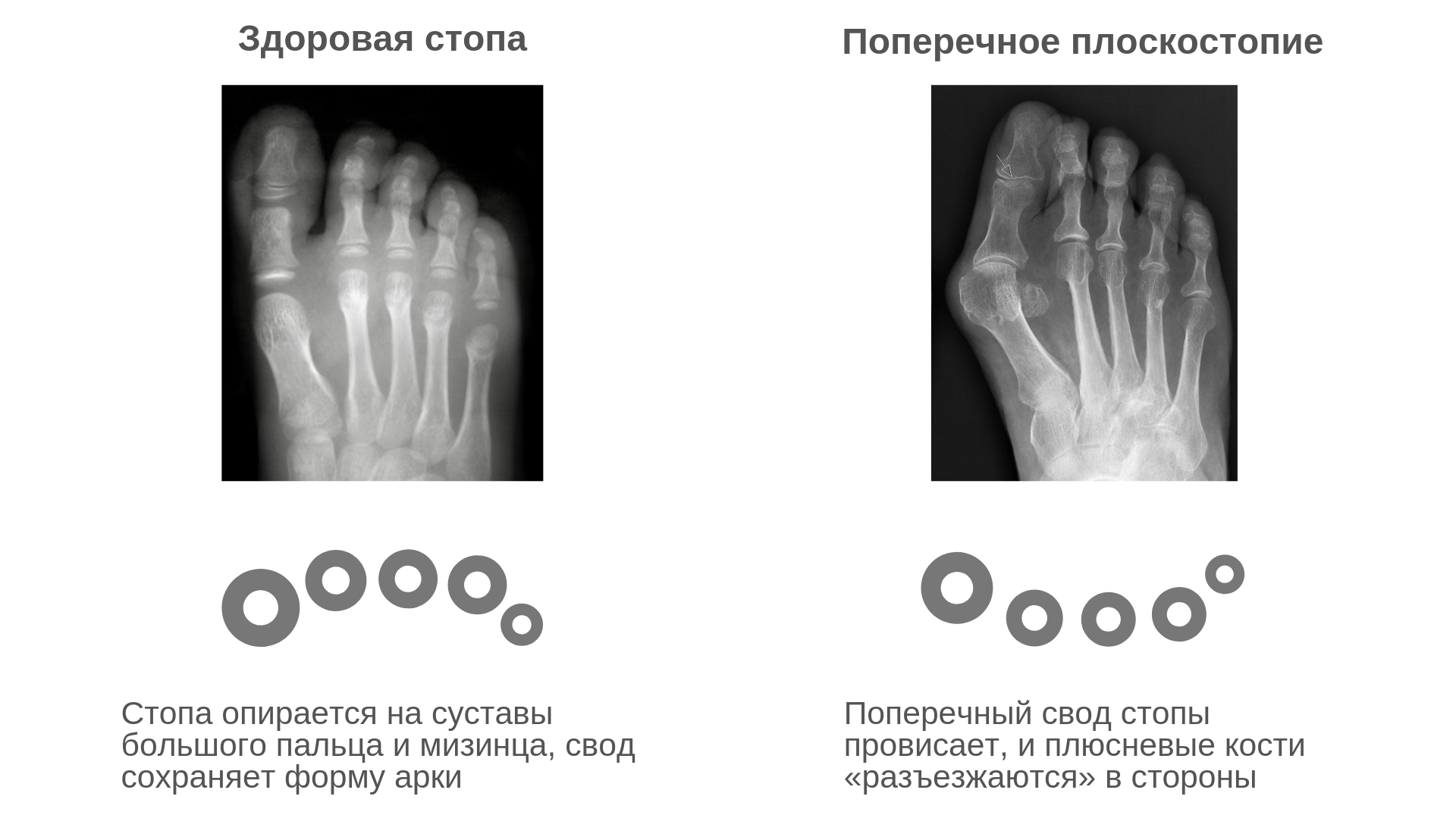 Ноги-ласты»: выявляем и корректируем поперечное плоскостопие