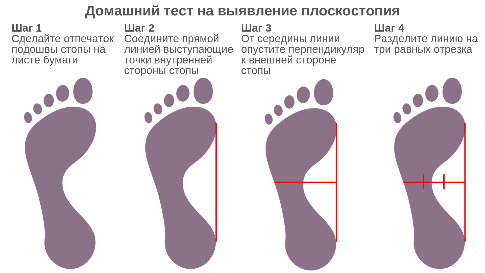 Как лечить плоскостопие