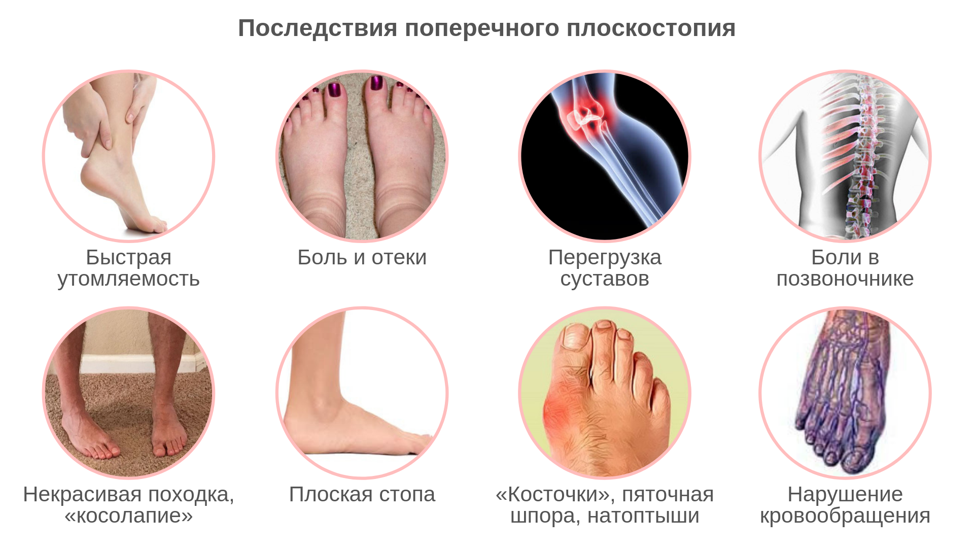 Весна и плоскостопие, или почему в межсезонье болят ноги? | Новости Новороссийска
