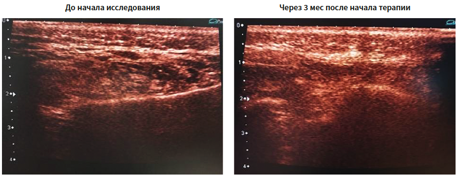 Hyalu B5(LRP) KM 4-2025_Fig.png
