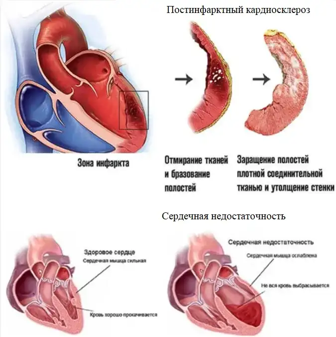 Болезни сердца