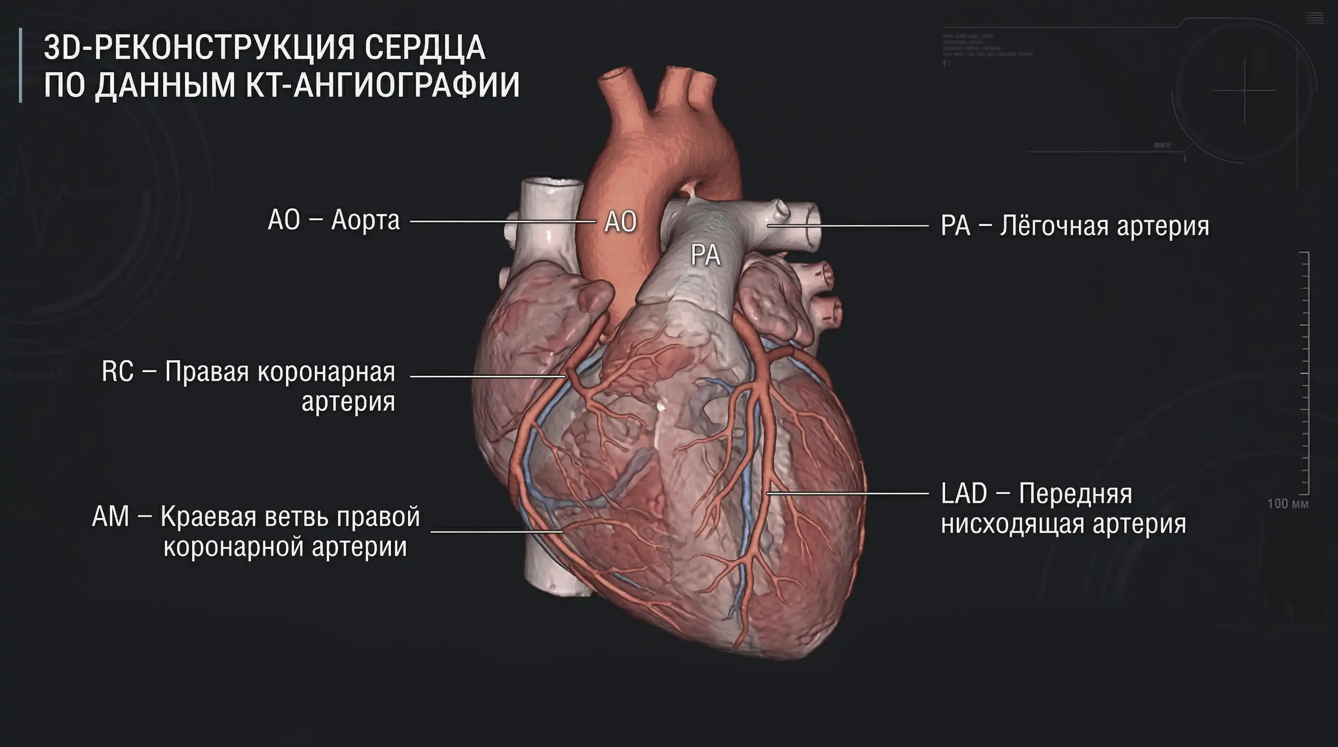 3D-реконструкция КТ сердца
