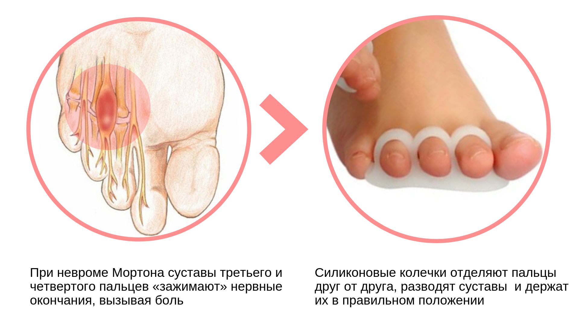 Корректоры-разделители на 3 пальца при невроме Мортона, 1 пара