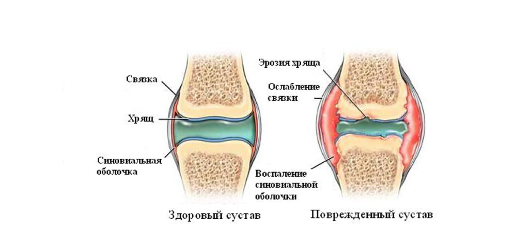 Артроз коленного сустава