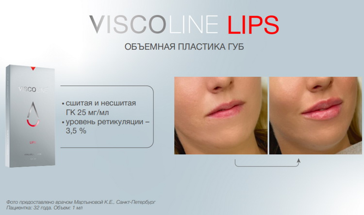 Viscoline Viscoline® Lips | 25 мг/мл | Филлер для губ | Купить в Москве с ...