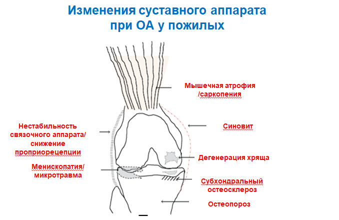 Субхондральный склероз суставных поверхностей коленного сустава. Проприорецепция стопы это.