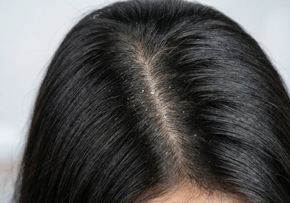 Перхоть зимой Перхоть зимой