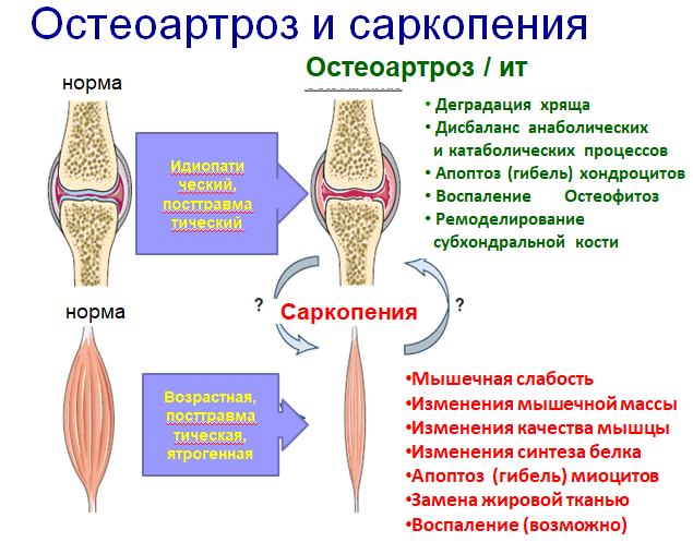 Саркопения это. Саркопения профилактика. Картинки предстадии саркопении.