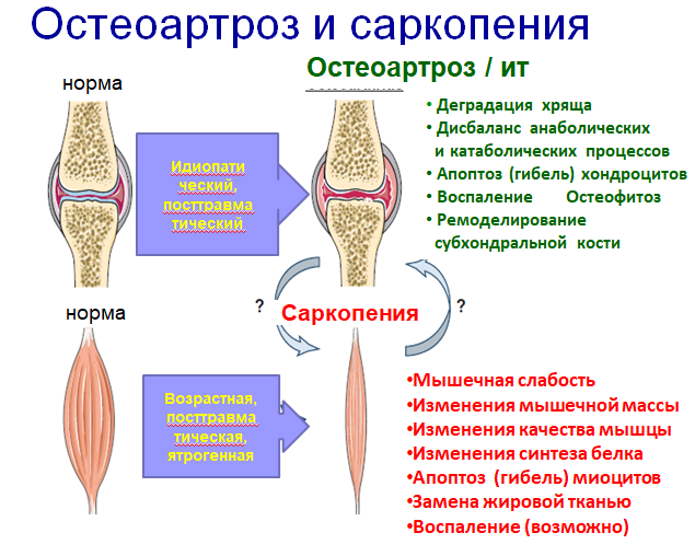 Механизмы развития остеоартроза