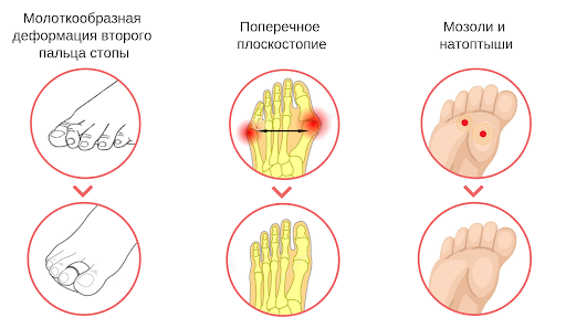 Молоткообразная деформация пальцев стопы