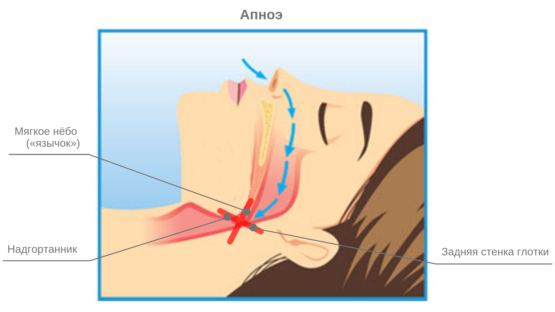Мягкое дыхание. Механизм формирования апноэ сна.