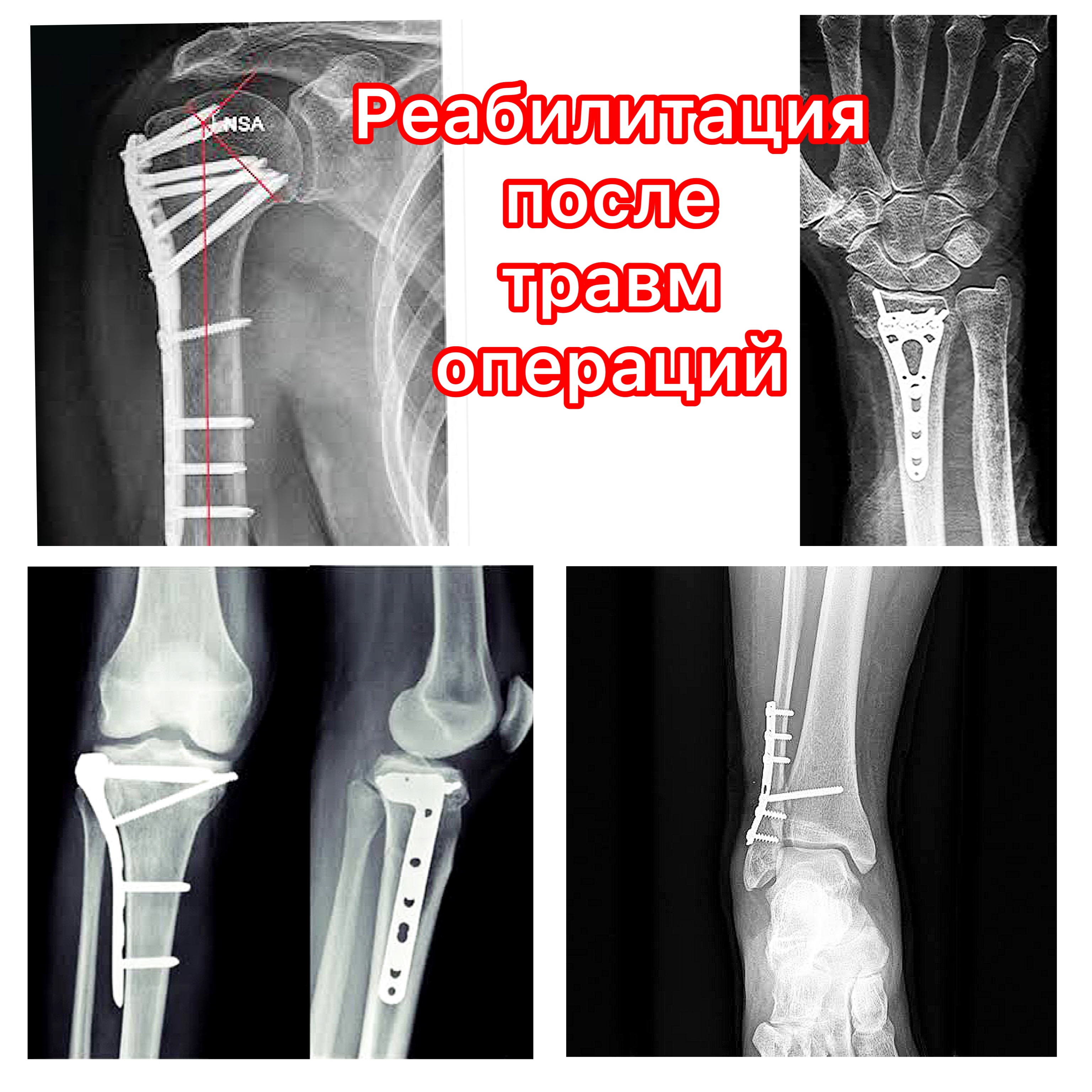 Отзывы после операции на суставе. Упражнения после остеосинтеза локтевого отростка. Перенапряжение связок пальца. Травматология консультация.