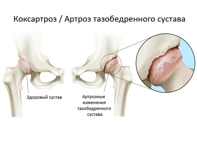 Коксартроз тазобедренного сустава