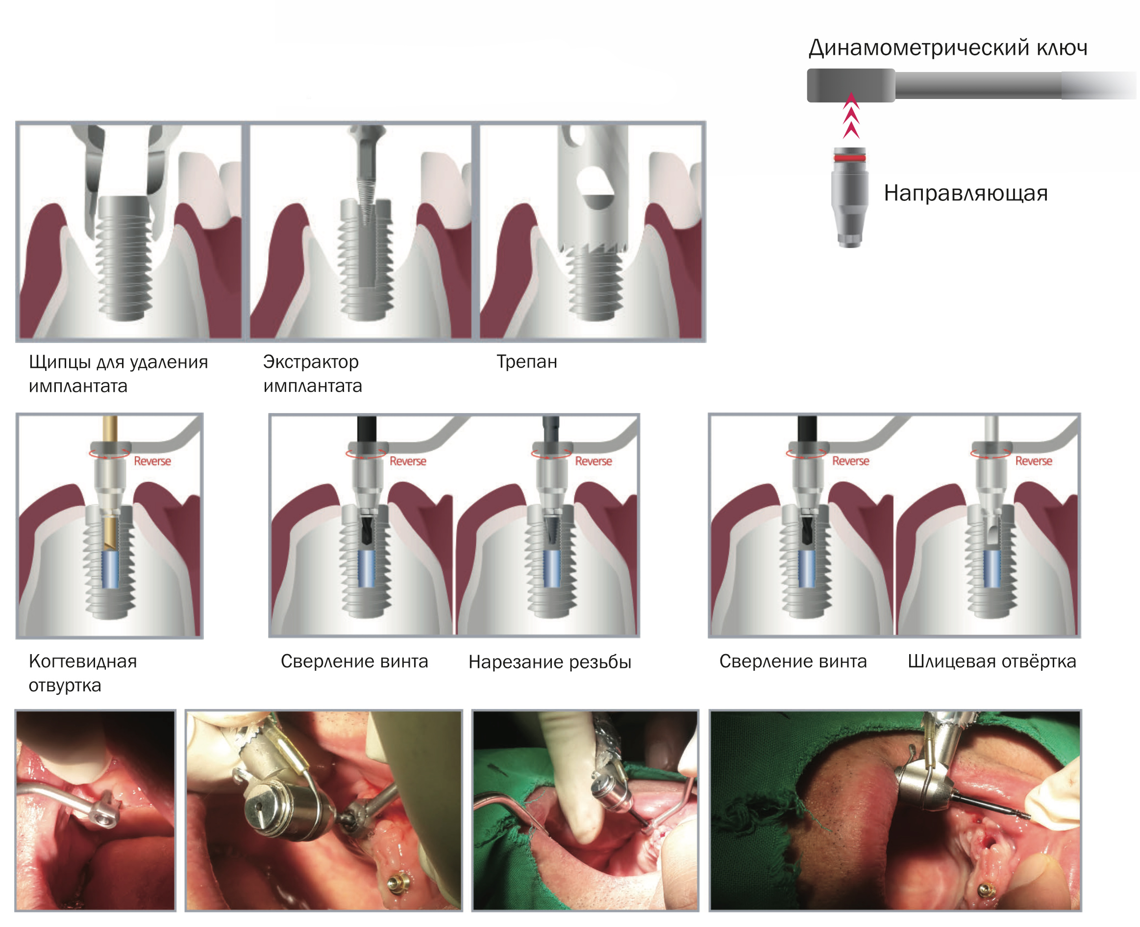 Dental Studio Implant & Screw Remover Kit