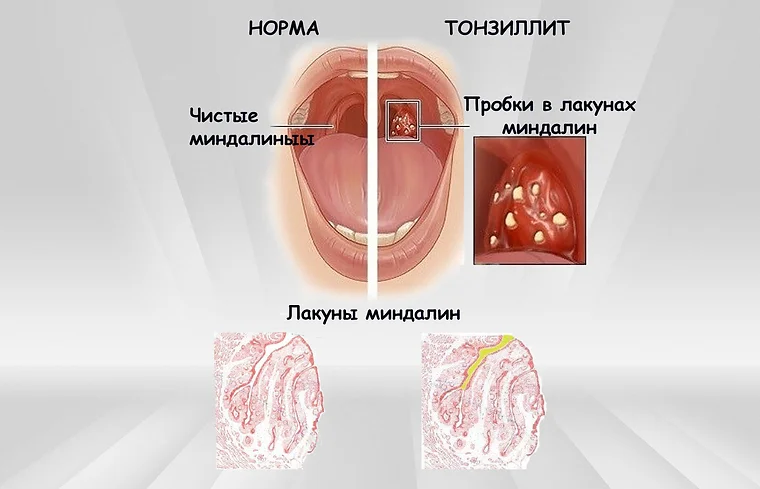 Казеозные пробки в горле: причины и лечение | Тонзилгон Н