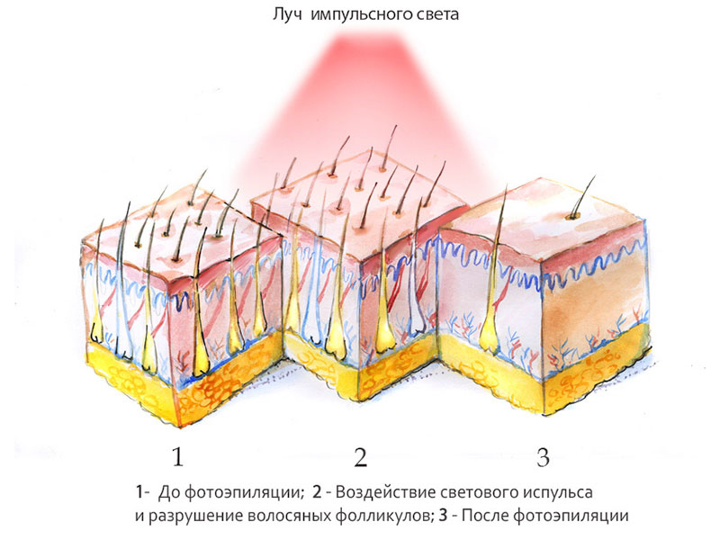 Технология воздействия импульсного света