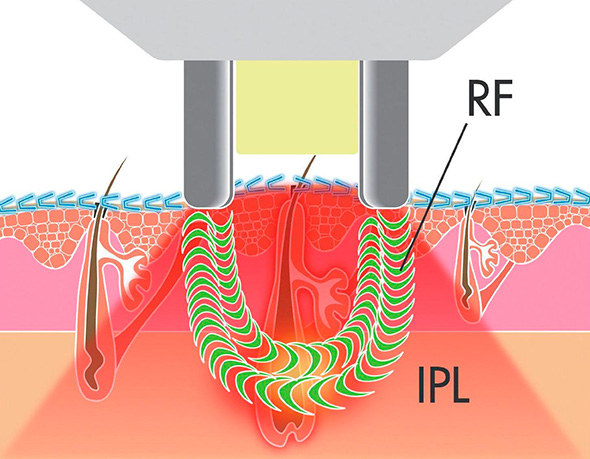 Технология воздействия элос-эпилятора на фолликул волоса