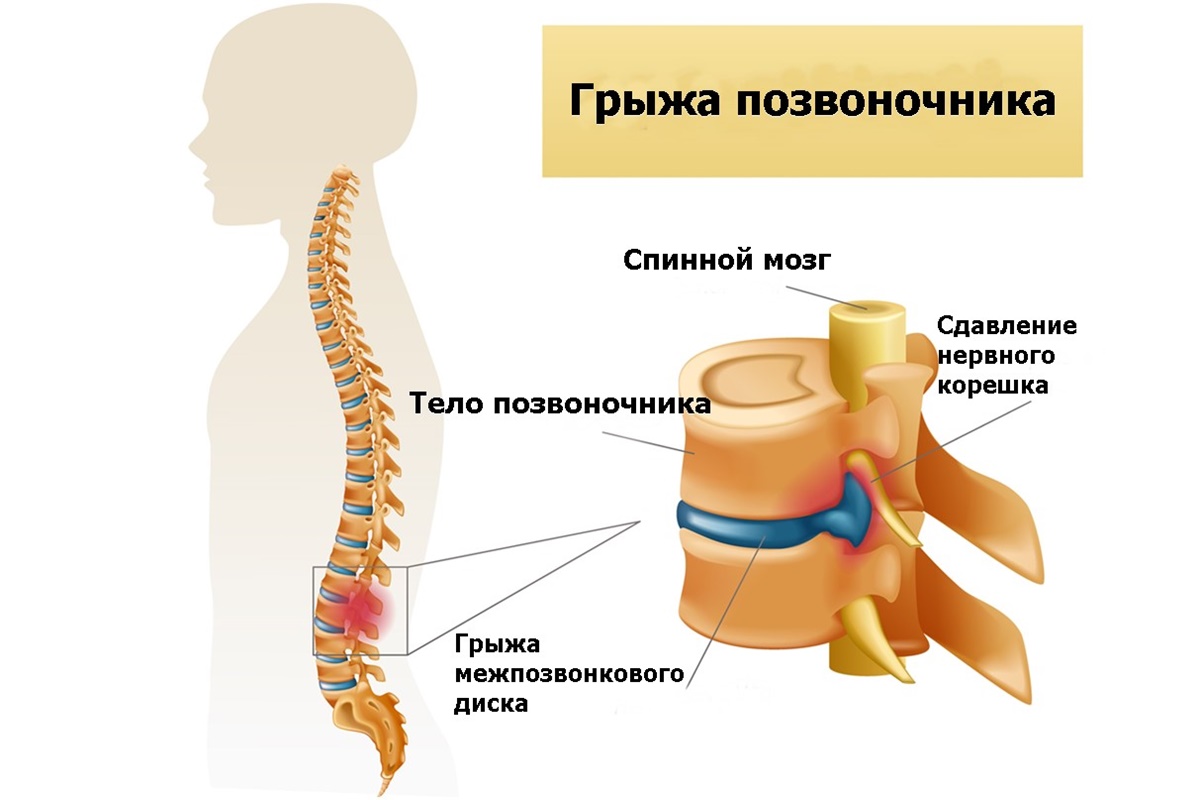 Протрузия поясничного отдела позвоночника