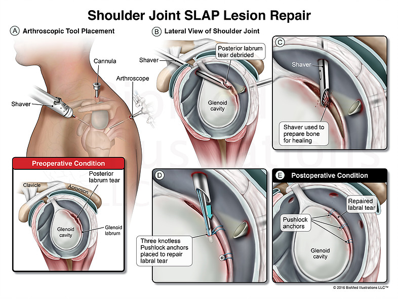 Slap синдром плечевого сустава классификация. Операция Банкарта плечевого сустава. Slap синдром плечевого сустава мрт. Разрыв гленоида плечевого.