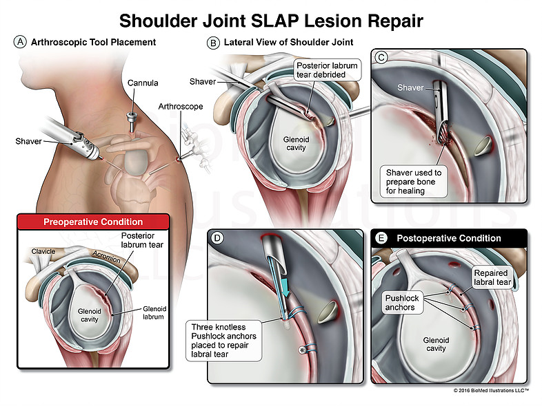 Повреждение губы плечевого сустава. Slap синдром плечевого сустава классификация. Операция Банкарта плечевого сустава. Slap синдром плечевого сустава мрт. Разрыв гленоида плечевого.