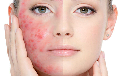 Крем и тоник против акне: как бороться с проблемой правильно