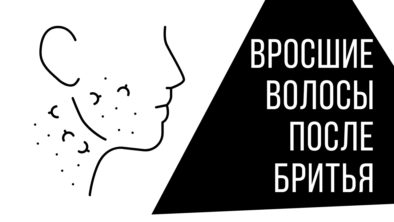 Вросшие волосы и как с ними бороться: избавься от вросших волос после бритья по-мужски