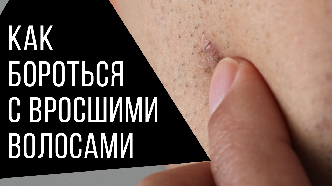 Вросшие волосы и как с ними бороться: избавься от вросших волос после бритья по-мужски