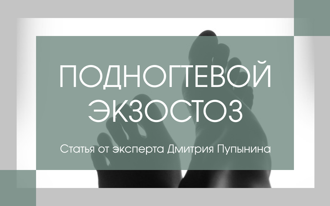 Подногтевой экзостоз