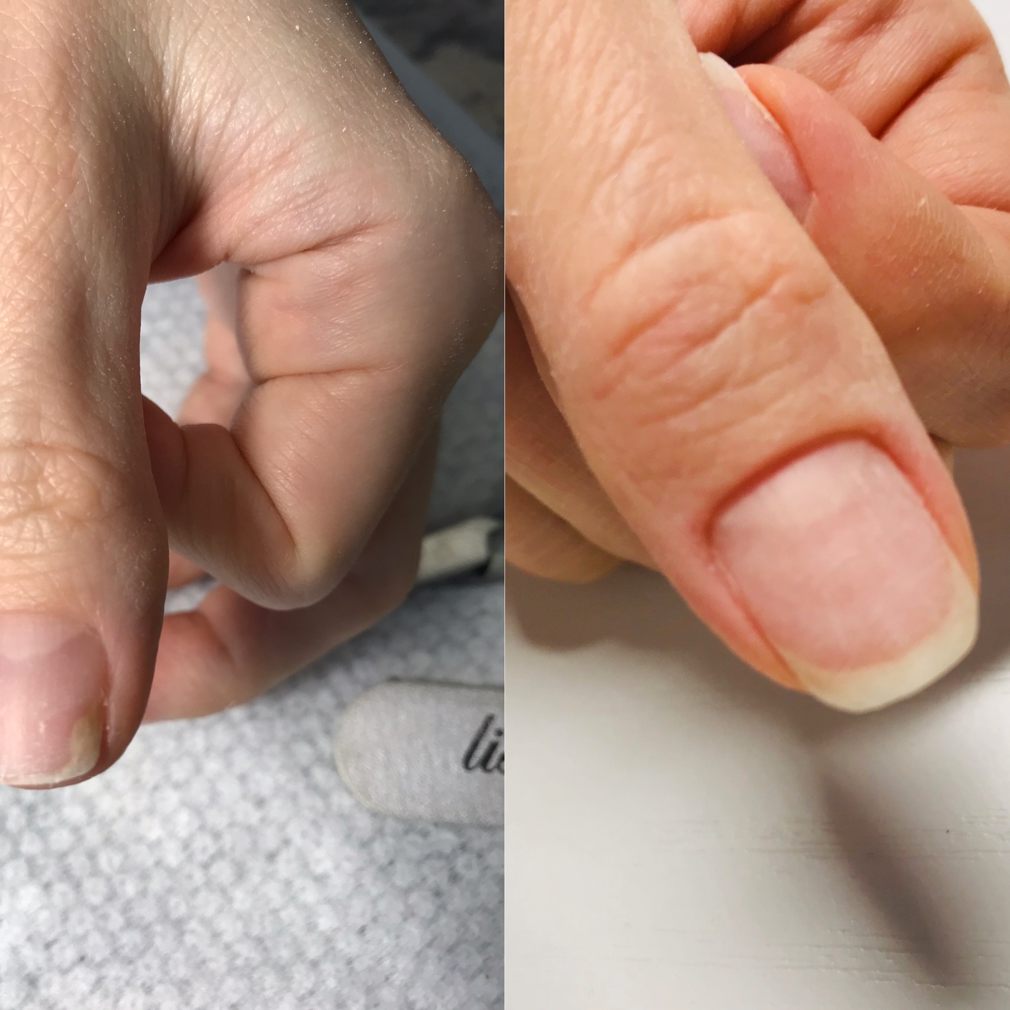 Лечение ногтей после гель. Неинфекционный онихолизис. Онихолизис ногтей онихолизис.