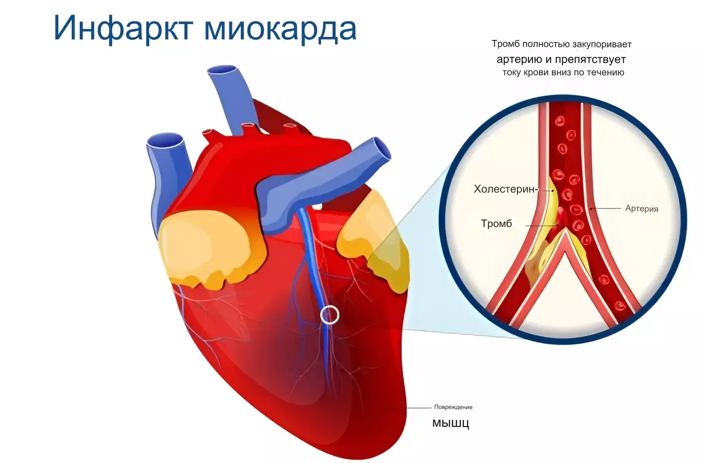 Инфаркт миокарда | Признаки, симптомы и лечение сердечного приступа
