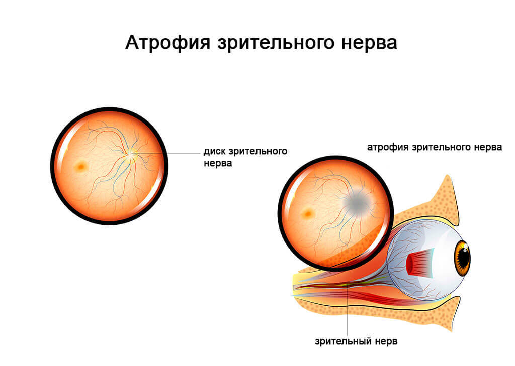 Презентация атрофия зрительного нерва