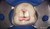 АШ Плюс (AH Plus)- двухкомпонентная паста для пломбирования каналов, Dentsply (4 мл+ 4 мл ) — фото 5