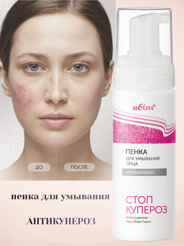 Стоп купероз Пенка для умывания лица 