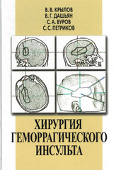Хирургия геморрагического инсульта