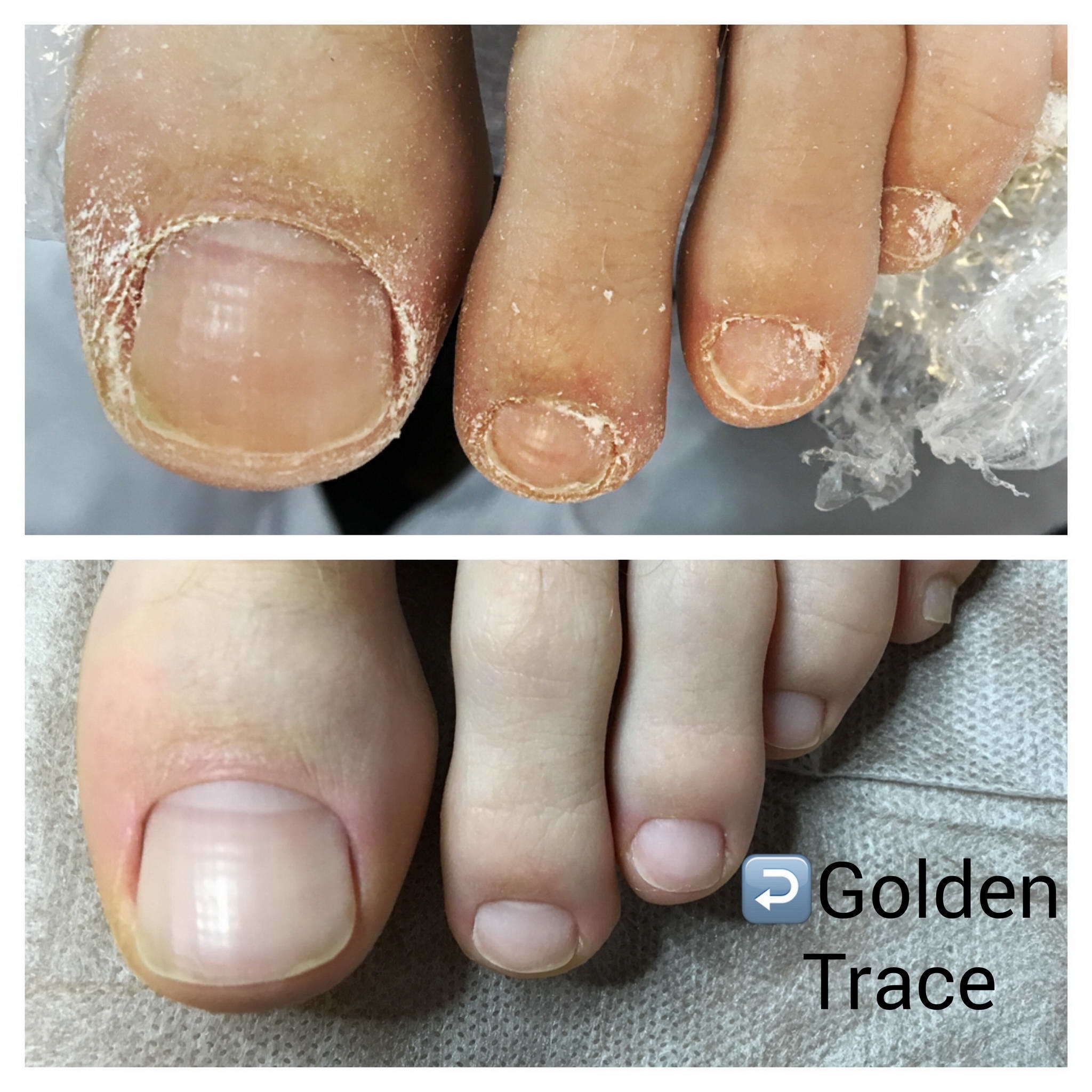 Проблемный педикюр. Ферментативный педикюр Golden Trace что это. Ногти до и после педикюра.