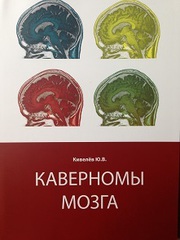 Каверномы мозга
