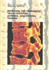 Переломы тел позвонков при остеопорозе: клиника, диагностика, лечение