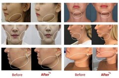 Липолитик для лица LIPO VELA-V 5 мл (1 шт.)