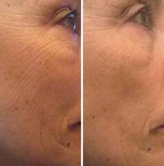 Набор - Профессиональная лифтинг маска для лица GD11 ESTHE RX LIFT-UP MASK SET (2гр x 8 шт) + 35 мл