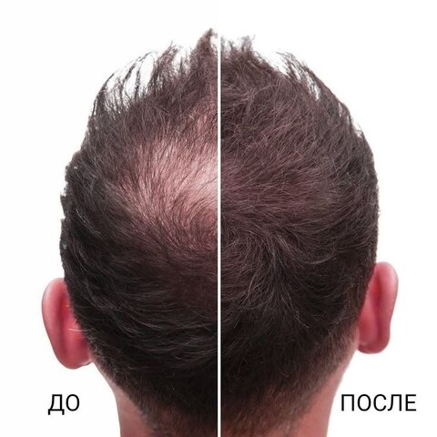 АЛОПЕЦИЯ (МУЖСКАЯ)