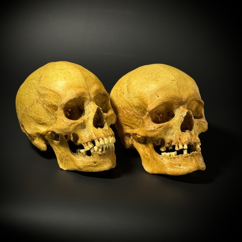 Мужской череп человека с метопизмом + женский череп человека с метопизмом (анатомические модели)