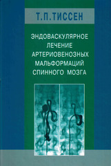 Эндоваскулярное лечение артериовенозных мальформаций спинного мозга