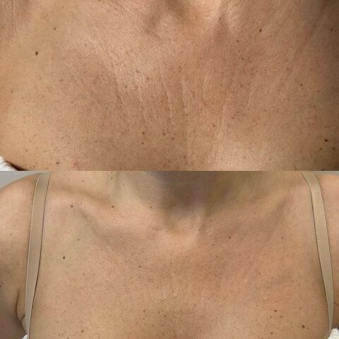 ОМОЛОЖЕНИЕ ЗОНЫ ДЕКОЛЬТЕ