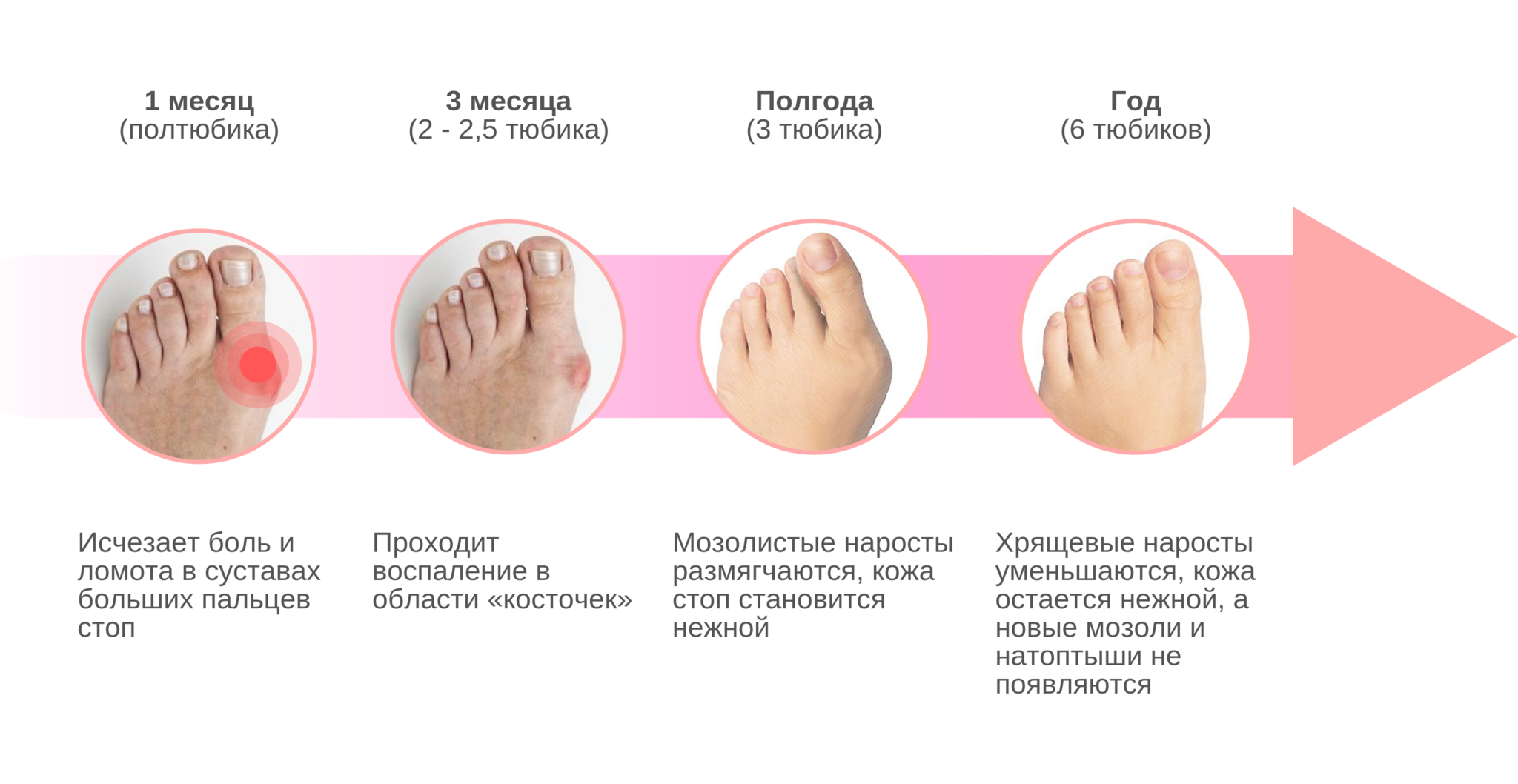Вальгусная деформация большого пальца ноги