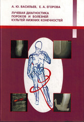 Лучевая диагностика пороков и болезней культей нижних конечностей