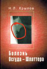 Болезнь Осгуда-Шлаттера