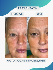 Masaru Botocurex Lifting Mask Set Маска мышечная с эффектом ботокса